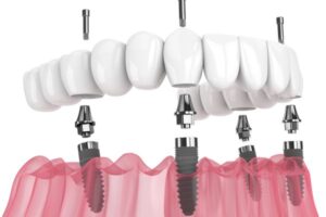 dental Implant Aberdeen