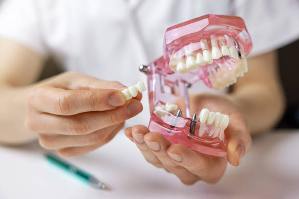 local dental implants