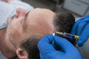 Hair Transplant - A Permanent & Natural Looking Solution To Hair Loss
