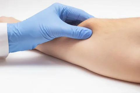 Lipoma Removal