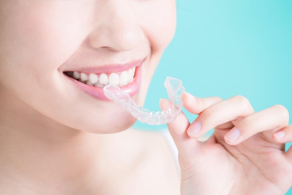 Invisible Aligners