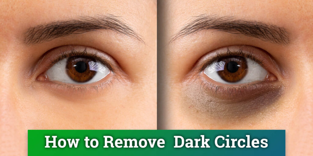 Dark Circles