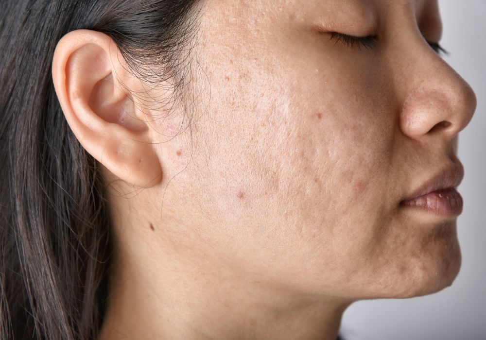Acne Scar Treatment in Dubai