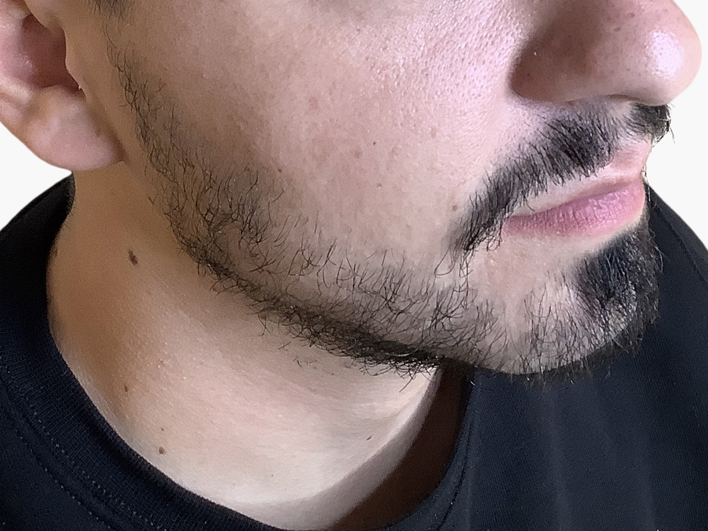 Beard Hair Transplants What to Expect During the Recovery Period