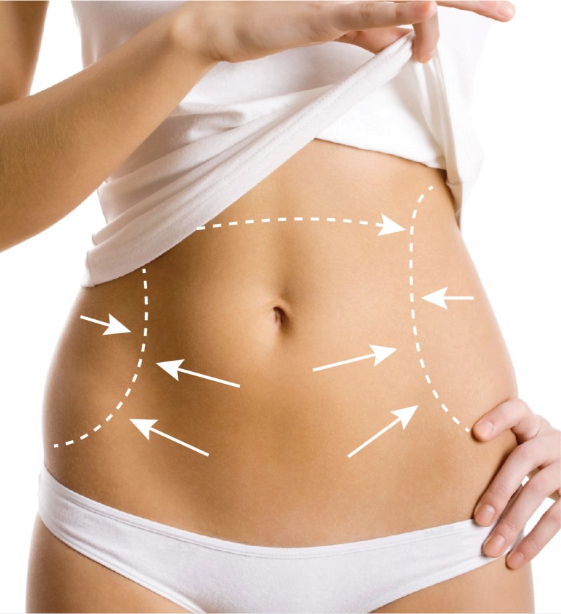 Does Laser Liposuction in Dubai Offer Permanent Results or Will the Fat Return
