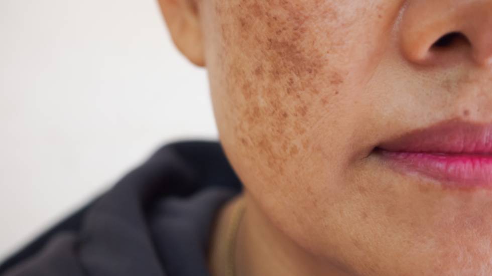 Freckles and Blemishes Treatment in Dubai