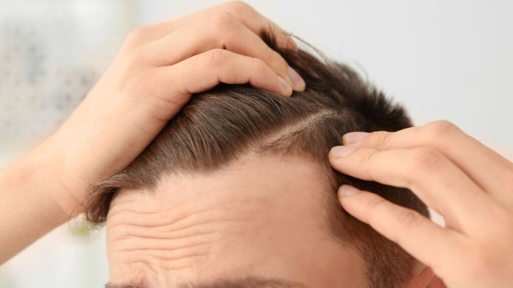 Is Finasteride for Hair Loss Used in All Ages