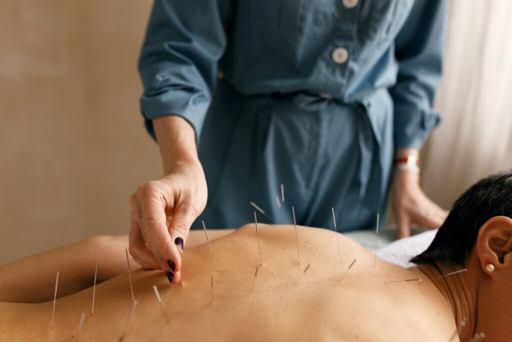 Acupuncture for Pain Relief