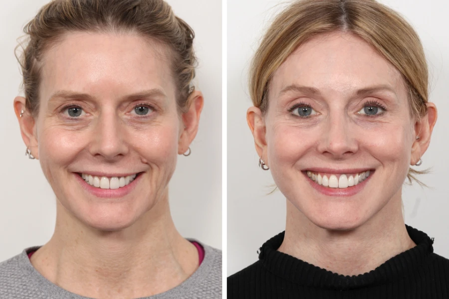 Thread Lift Treatments in Dubai: Do They Hurt?