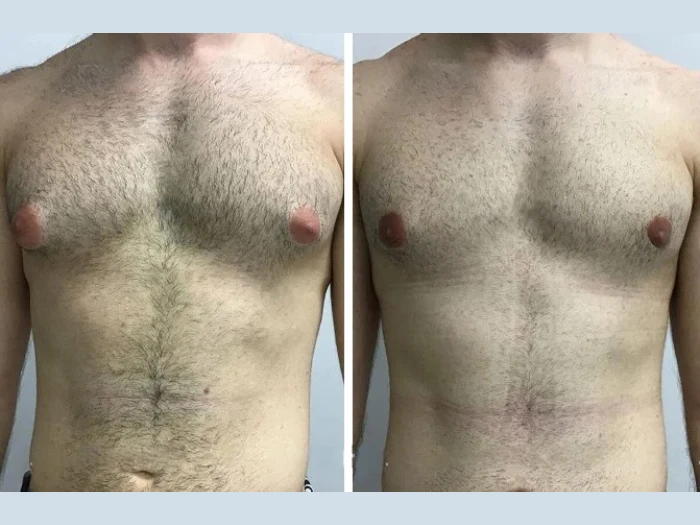 Best Doctors in Dubai for Male Chest Contouring Surgery