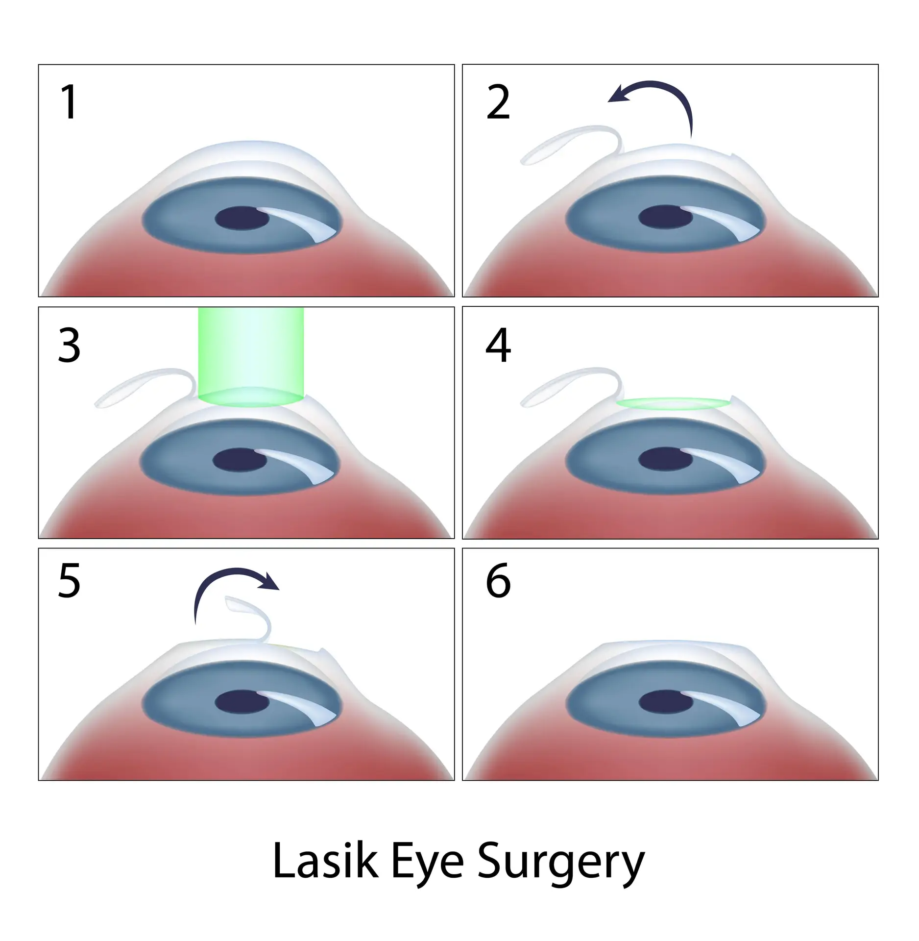 lasik eye surgery in woodbridge va