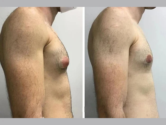 gynecomastia in dubai