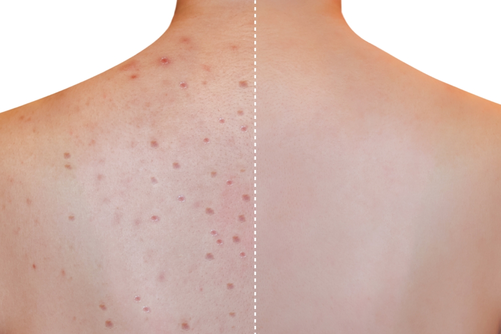 Metro Boston acne research studies
