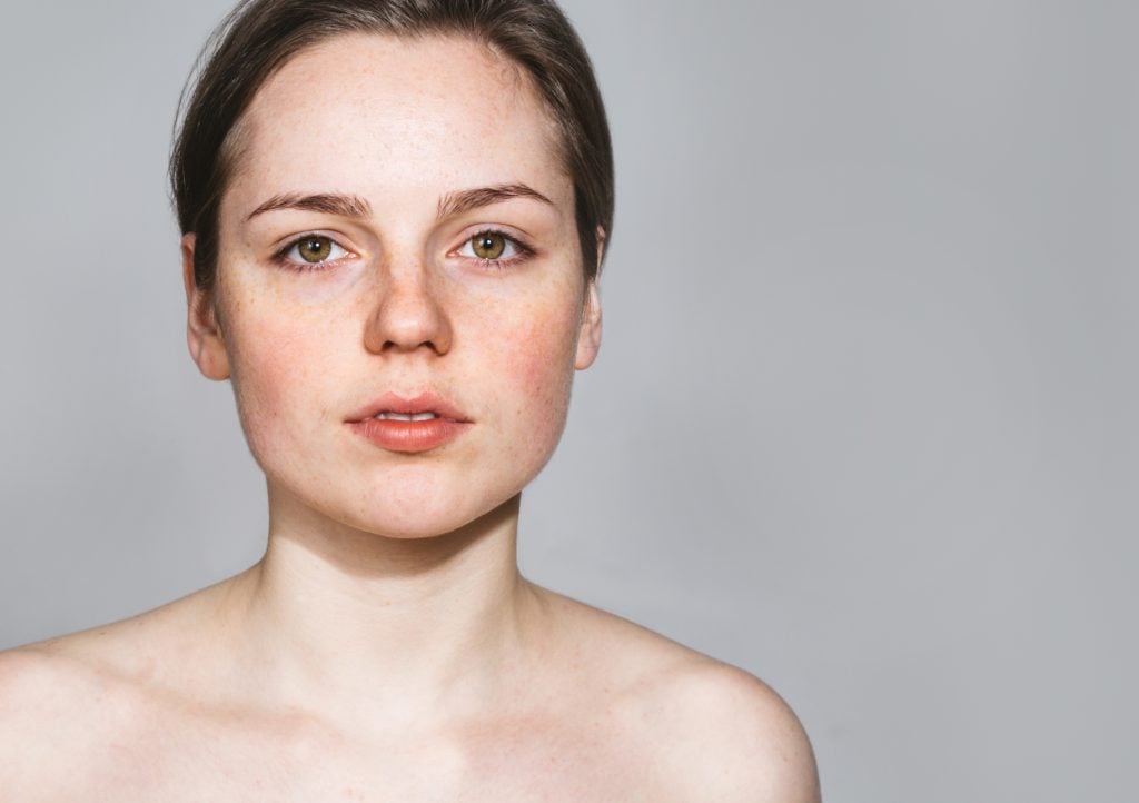 Acne Treatment In Dubai