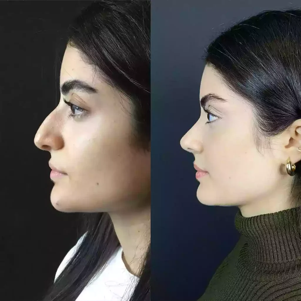 Rhinoplasty in Dubai: Trusted Surgeons for Lasting Results