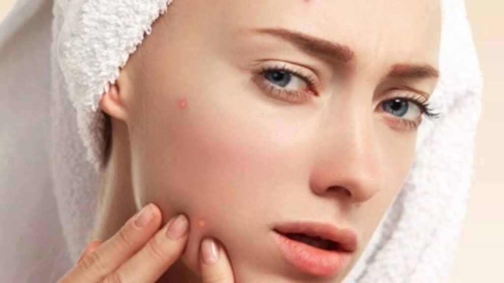 Professional Acne Treatment in New Lenox IL for Clear and Healthy Skin