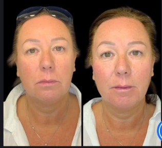 Look Without Surgery – Non-Surgical Facelift Treatments in Dubai