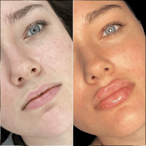 Enhance Your Beauty with the Best Doctors in Dubai for Fillers
