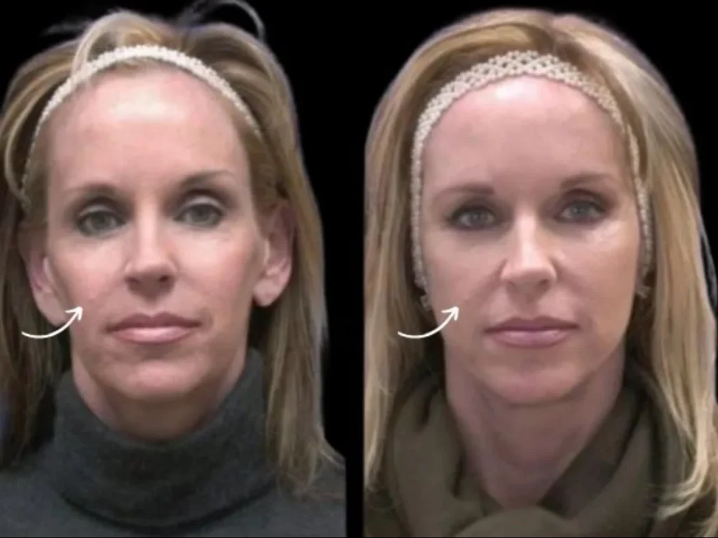 Long-Lasting Beauty Achieved Through Sculptra Fillers Treatments in Dubai