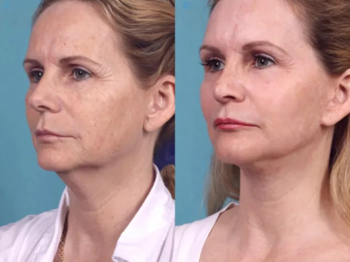 The Ultimate Skin Refresh at the Best Aesthetic Clinic in Dubai with Chemical Peels