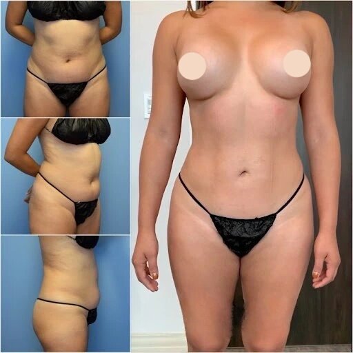 Body Contouring Surgery in Dubai