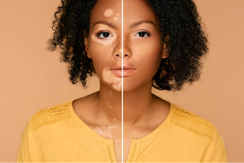 Vitiligo face