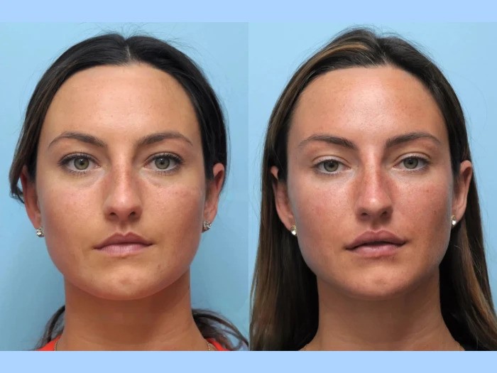 Facial Sculpting Made Simple Through Thread Lift Treatment in Dubai