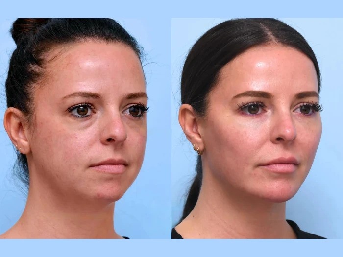 Thread Lift Treatment in Dubai Supports Collagen for Long-Term Results