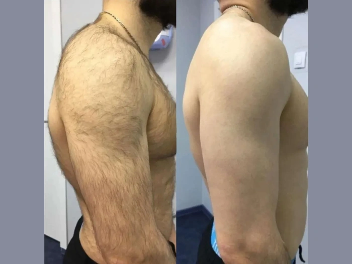 Laser hair removal in Dubai