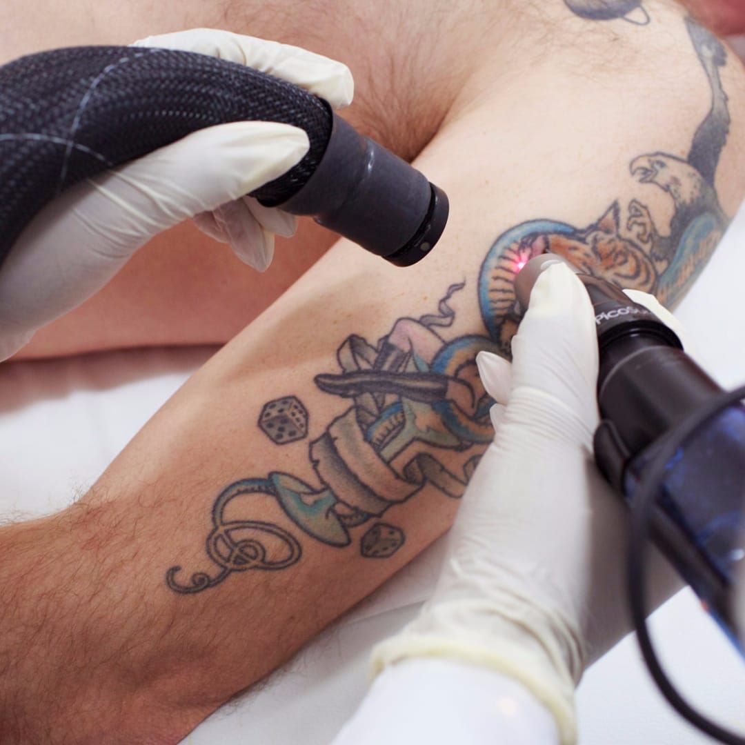 Laser Tattoo Removal in Riyadh