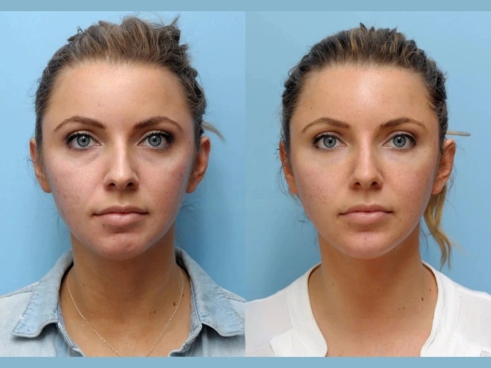 Best Aesthetic Clinic in Dubai Ensures Perfect Thread Lift Results
