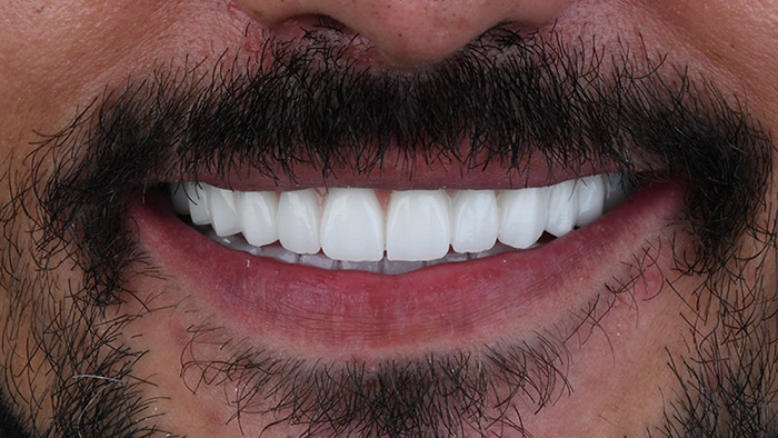Veneers Dubai