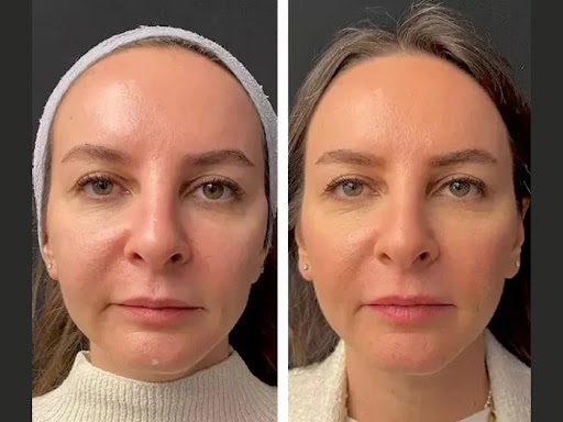 Mesotherapy Treatments in Dubai