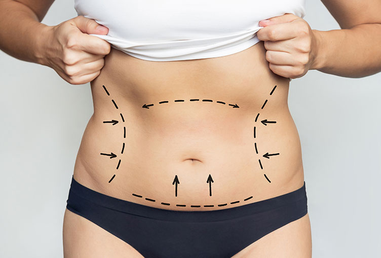 Liposuction Dubai