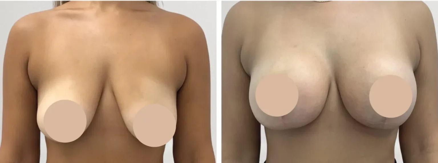 Breast lift in Dubai