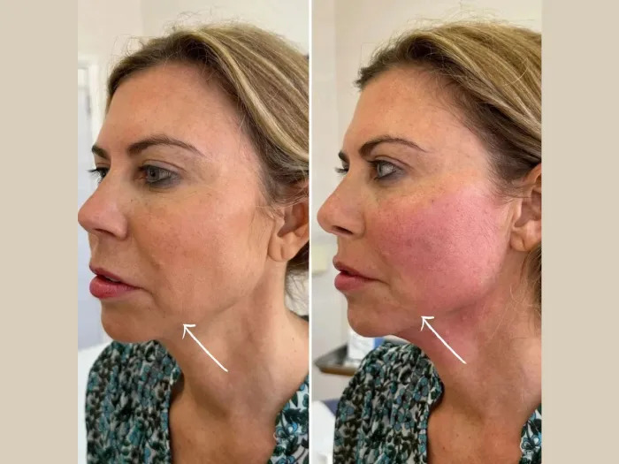 Best Aesthetic Clinics in dubai Recommend Endolift for Jawline and Neck Contouring