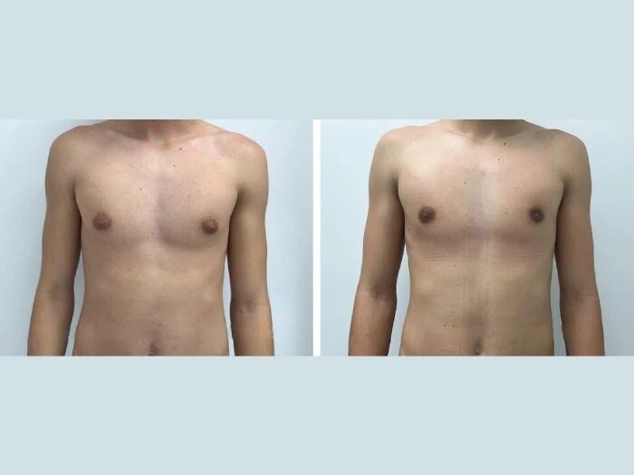 gynecomastia in dubai