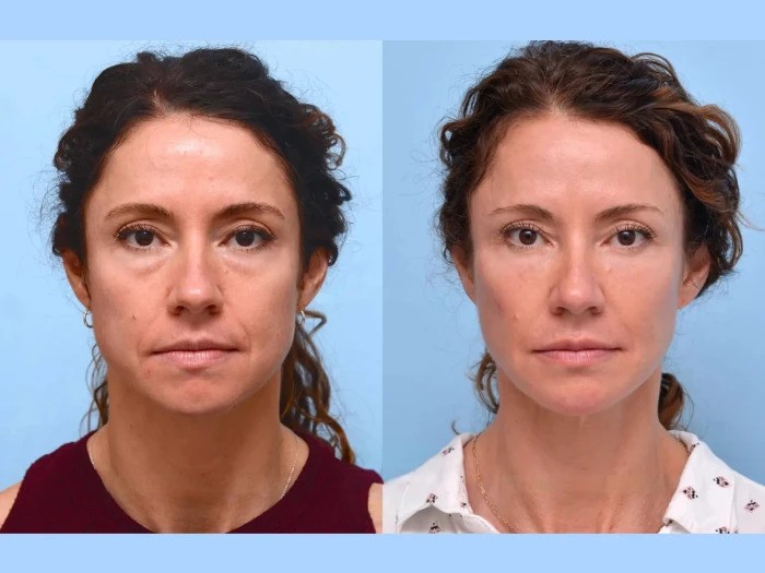 Thread Lift Treatment in Dubai Creating Youthful Facial Contours