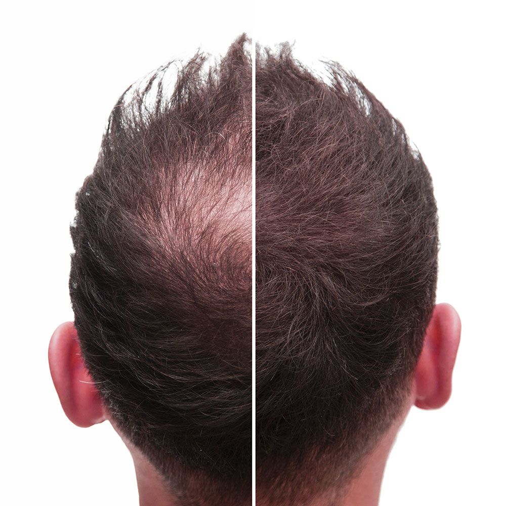 Hair Transplant in Riyadh