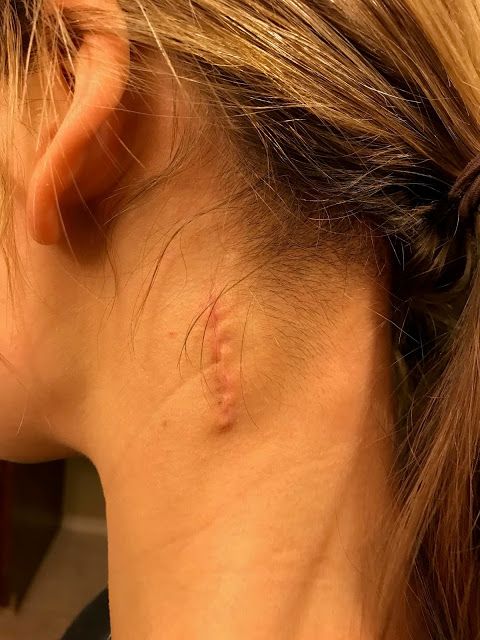 Laser Scar Removal in Riyadh