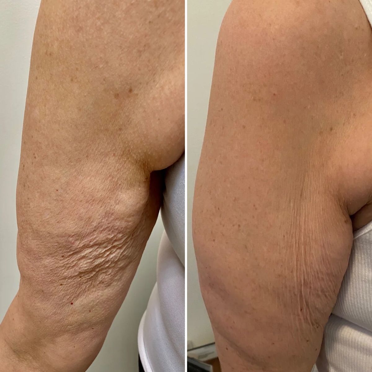 Lipedema Treatment in Riyadh