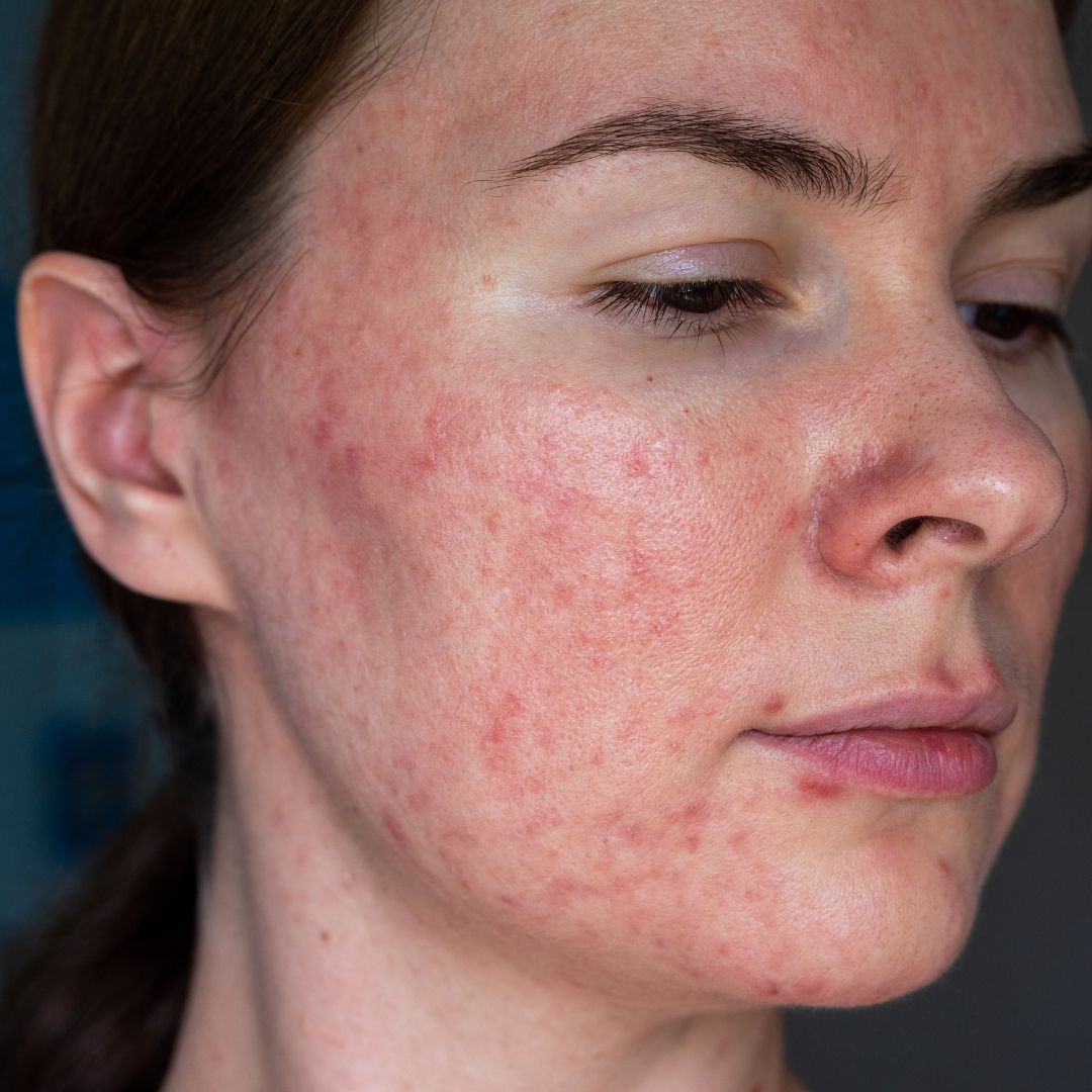 Pigmentation Treatment in Riyadh