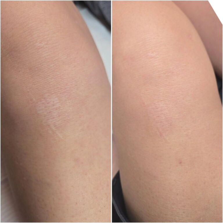 Stretch Mark Removal in Riyadh