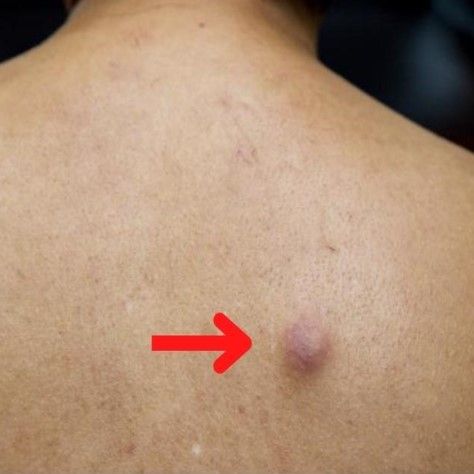 Warts Removal in Riyadh