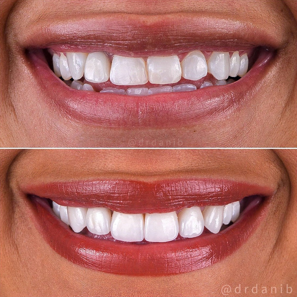 affordable dental veneers