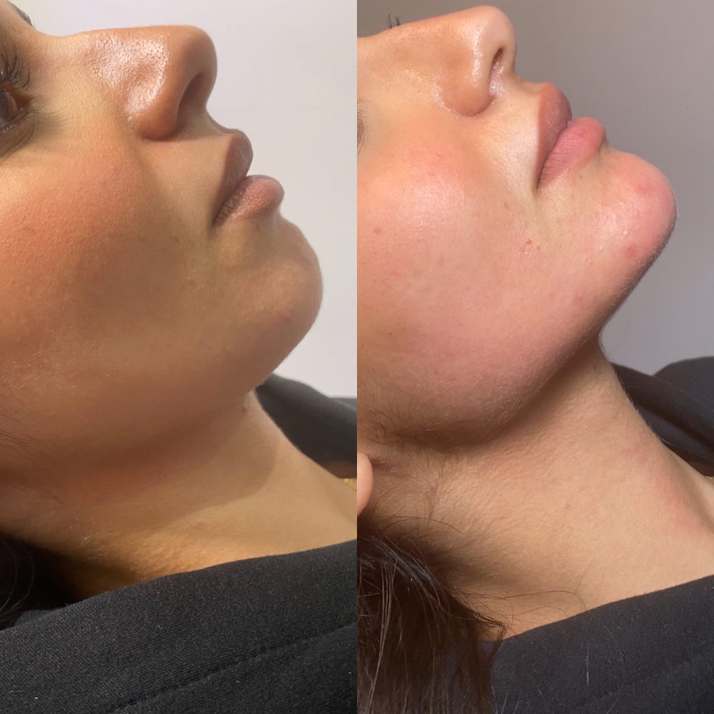 Chin Botox before and after results at SF Aesthetic Medspa