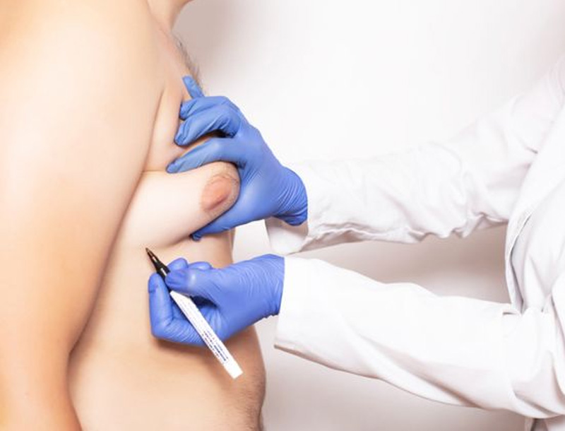 Gynecomastia