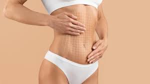 vaser liposuction in dubai