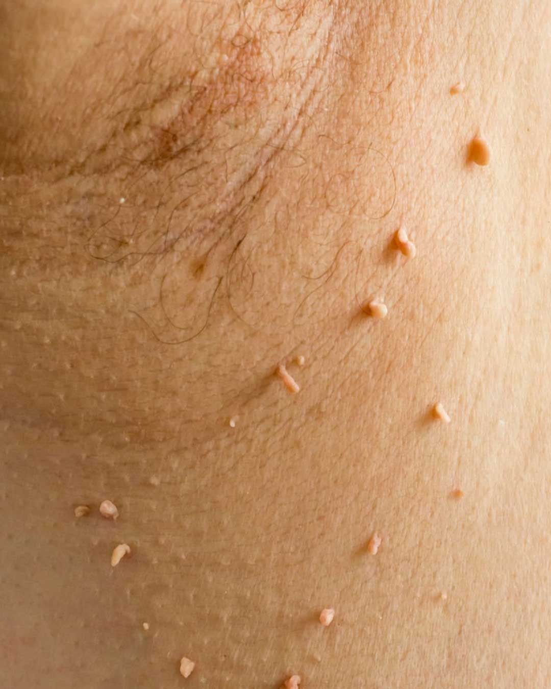 إزالة الزوائد الجلدية في الرياض