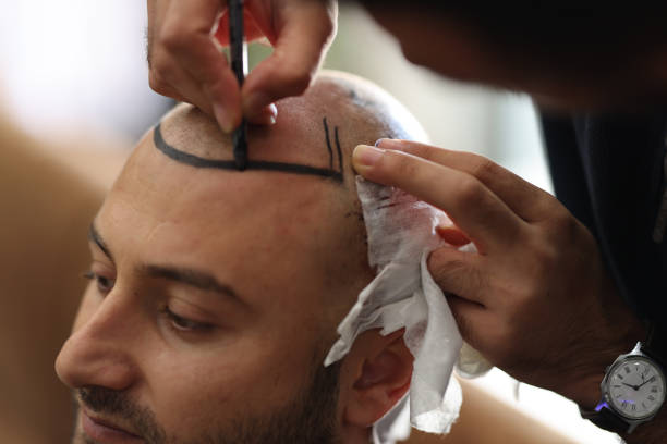 زراعة الشعر في الرياض